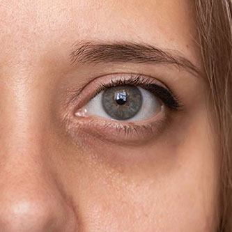 Dark Circles Under Eyes
