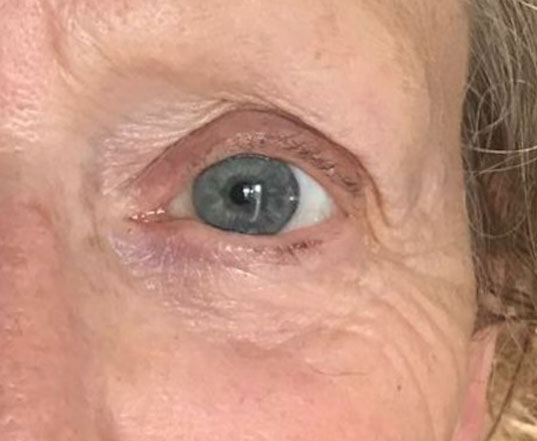 Before & After Plasma Treatment after image