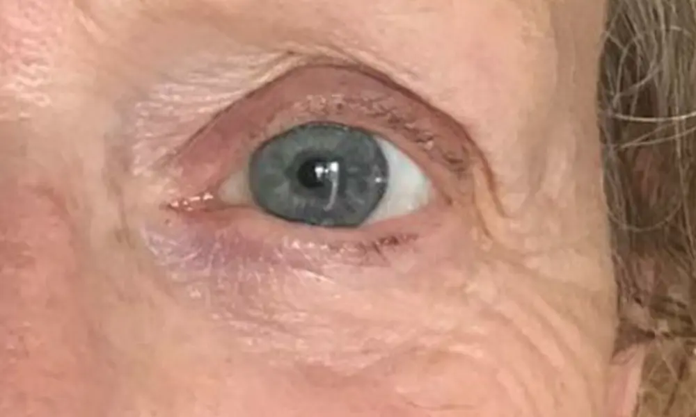 Before & After Plasma Treatment after image