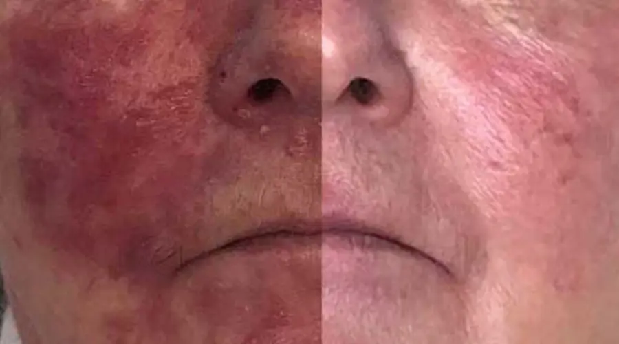 Rosacea awareness month