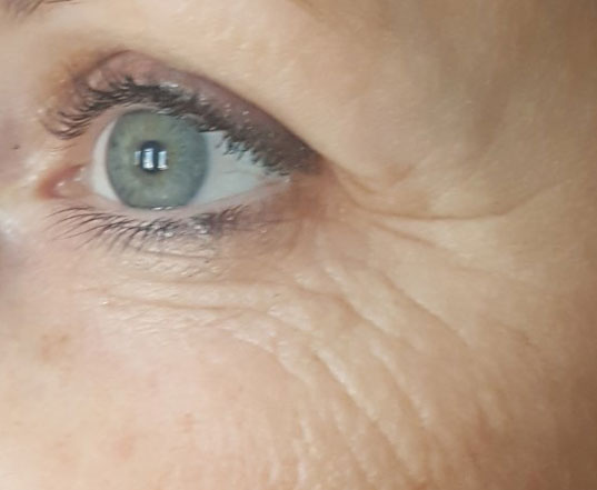 Before & After A-Lift Treatment before image