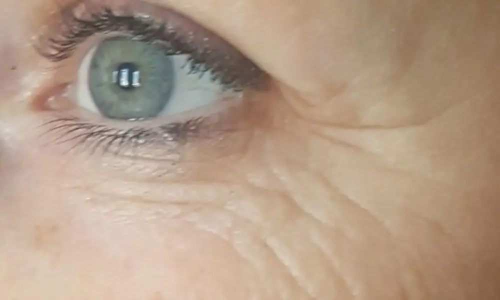 Before & After A-Lift Treatment before image