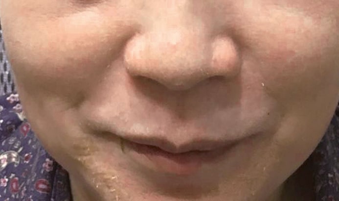 Before & After Cosmelan Treatments after image