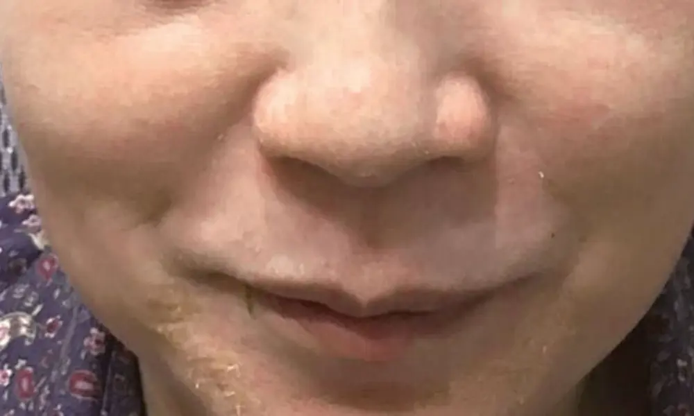 Before & After Treatment after image