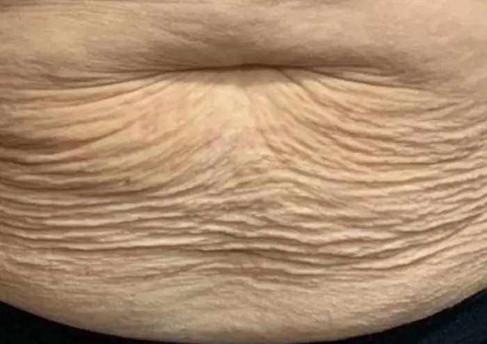Loose Skin Ribs Loose Skin Rachel Staggs Aesthetics