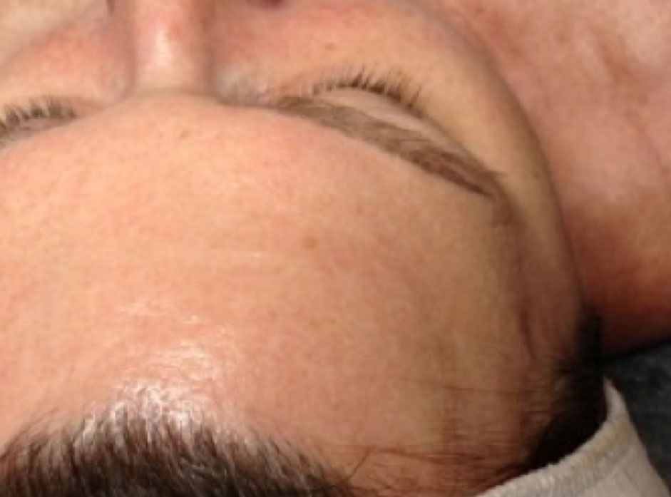 Before & After Forehead Lines Treatment after image