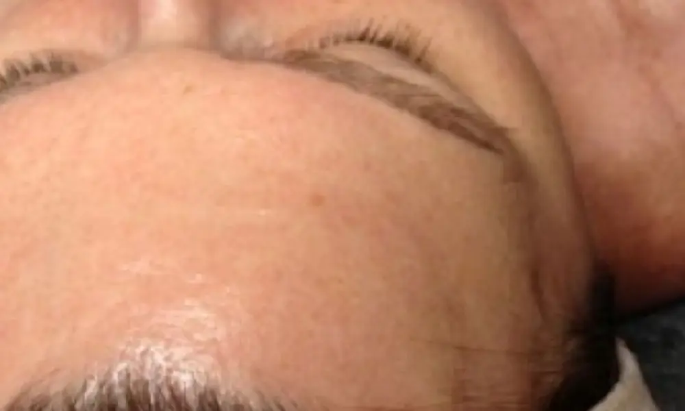 Before & After Forehead Lines Treatment after image