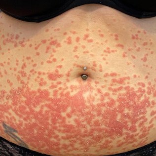 Before & After Treatment before image