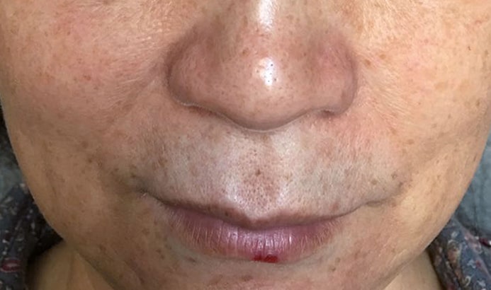 Before & After Cosmelan Treatments before image