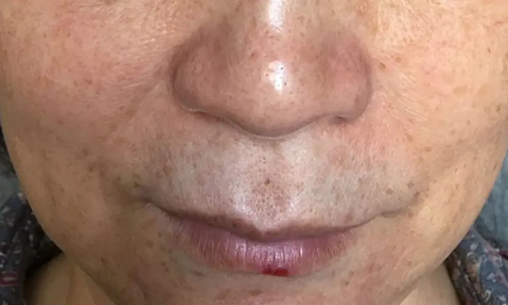 Before & After Treatment before image