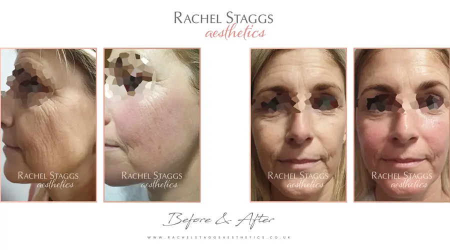 'A-Lift' to improve your skin's structure