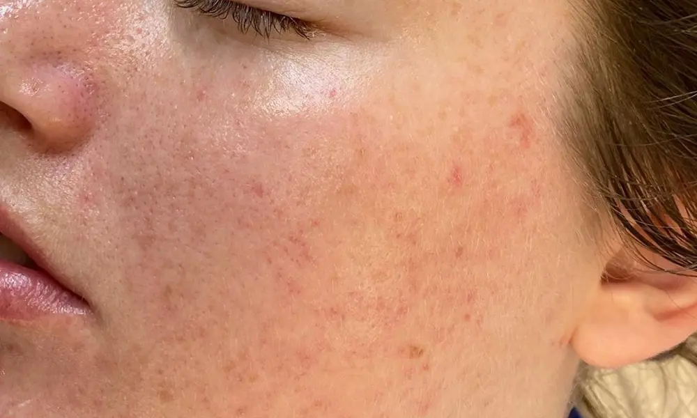 Before & After Acne Treatments after image