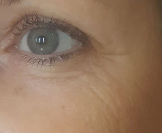 Before & After A-Lift Treatment after image