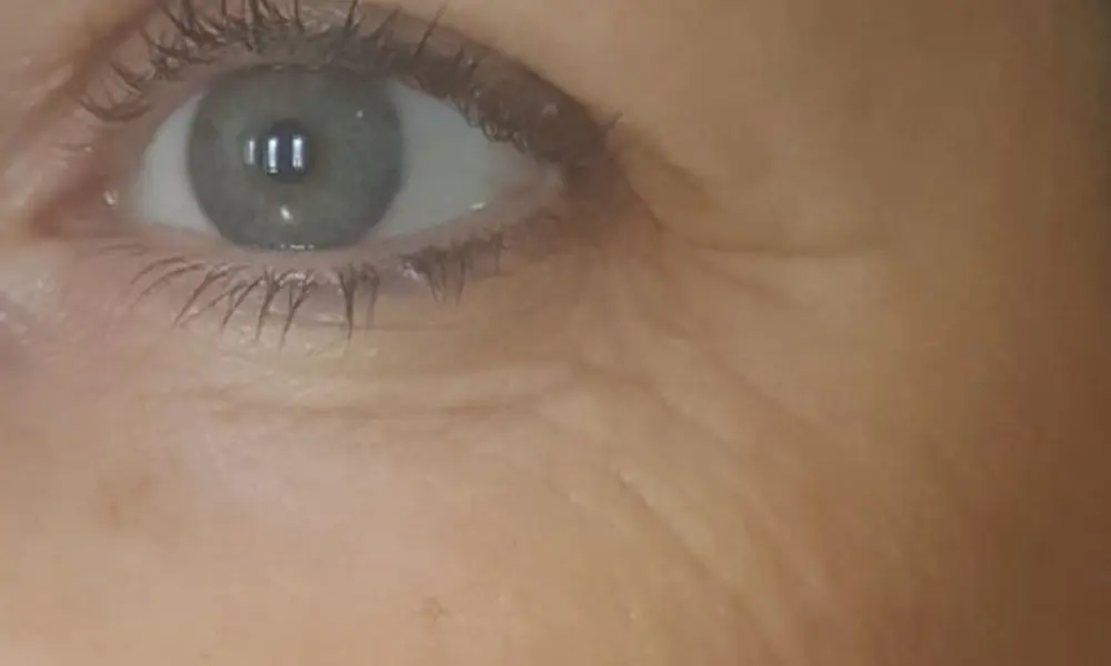 Before & After A-Lift Treatment after image