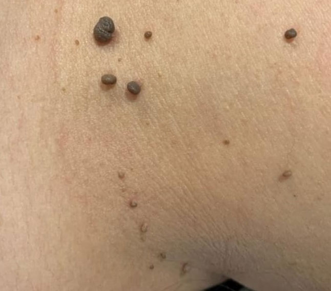 Before & After Treatment before image