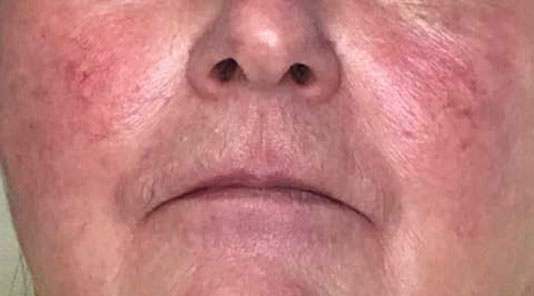 Before & After Treatment after image