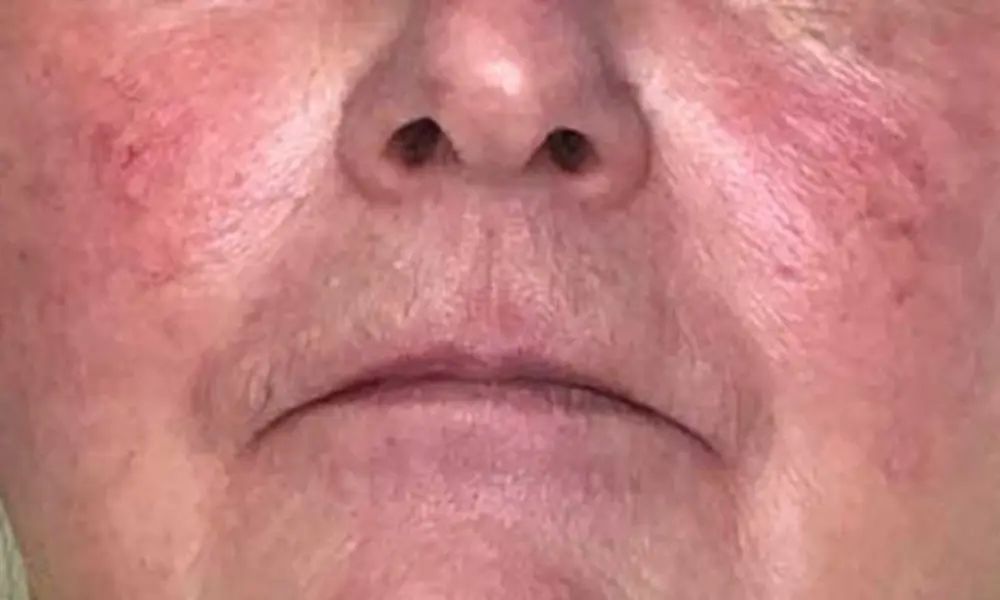 Before & After AlumierMD Treatments after image