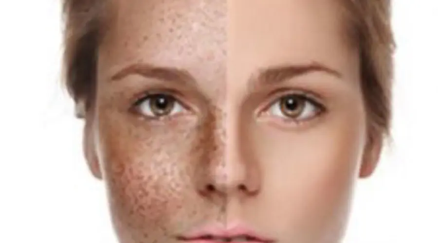 Skin Clinic - Sun Damage Pigmentation