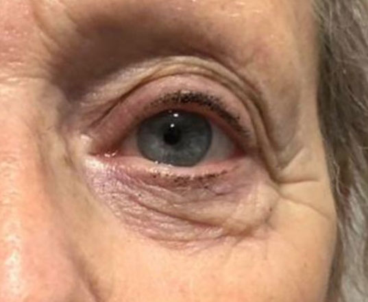 Before & After Plasma Treatment before image