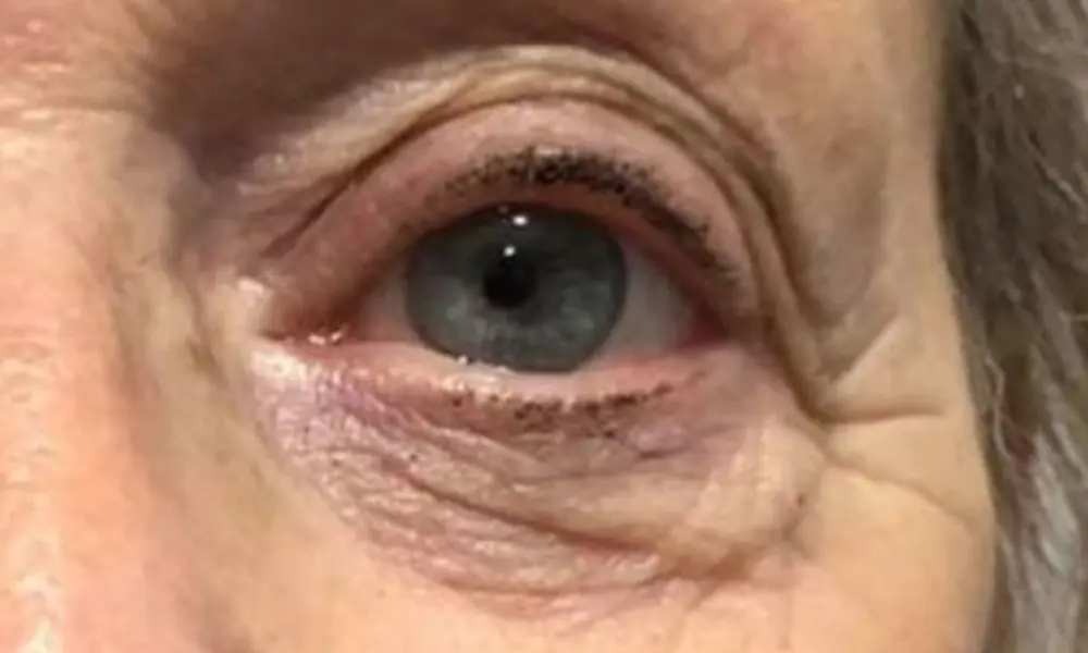 Before & After Plasma Treatment before image