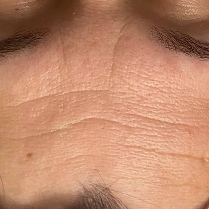 Before & After Dermalux Treatments before image