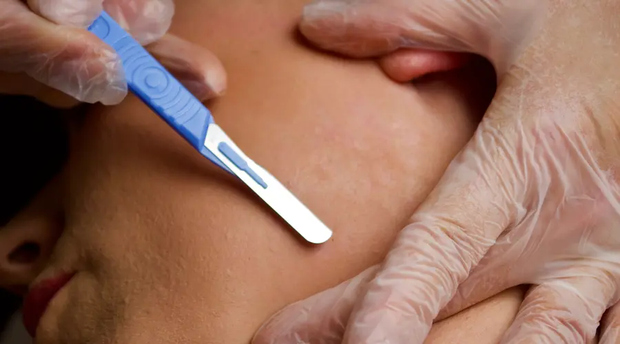 Dermaplaning – Does it make your hair stand on end?