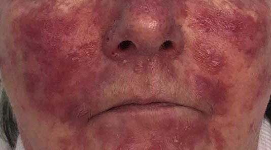 Before & After Treatment before image