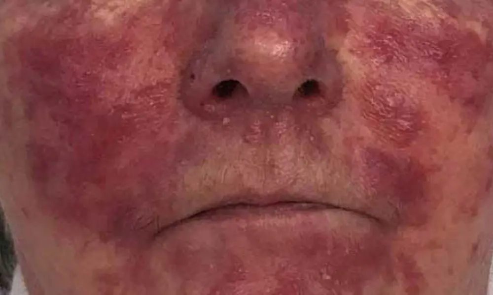 Before & After AlumierMD Treatments before image