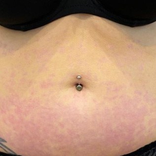 Before & After Treatment after image