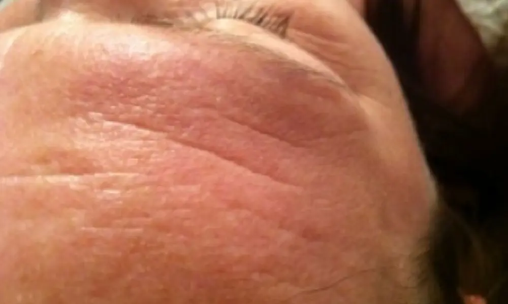 Before & After Forehead Lines Treatment before image