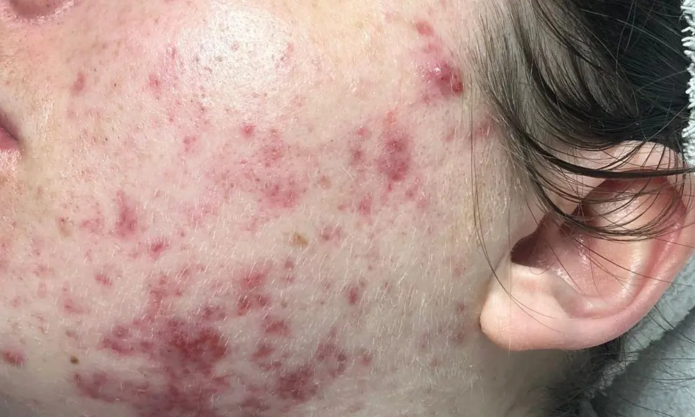 Before & After Acne Treatments before image