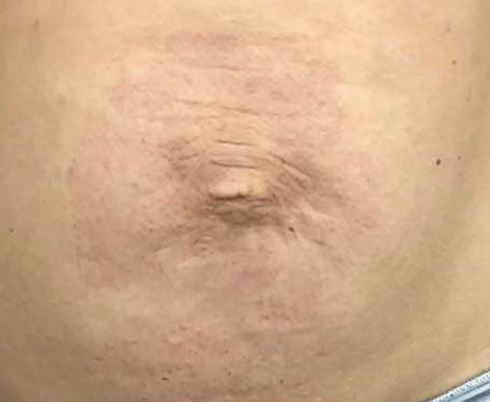 Before & After Treatment after image