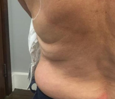 Upper body back fat hotsell